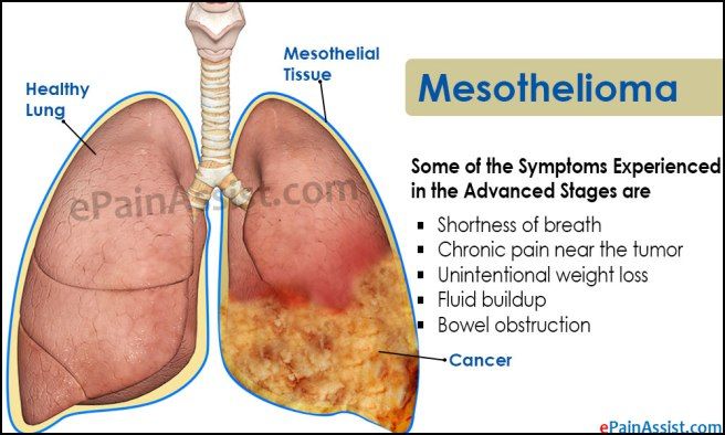 Mesothelioma Symptoms And Cure