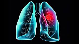 Major Causes Of Lung Cancer And How To Prevent Them