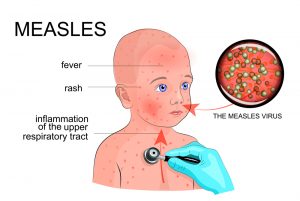 Test Measles With The New Device