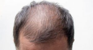 Do You Think Baldness Can Be Treated